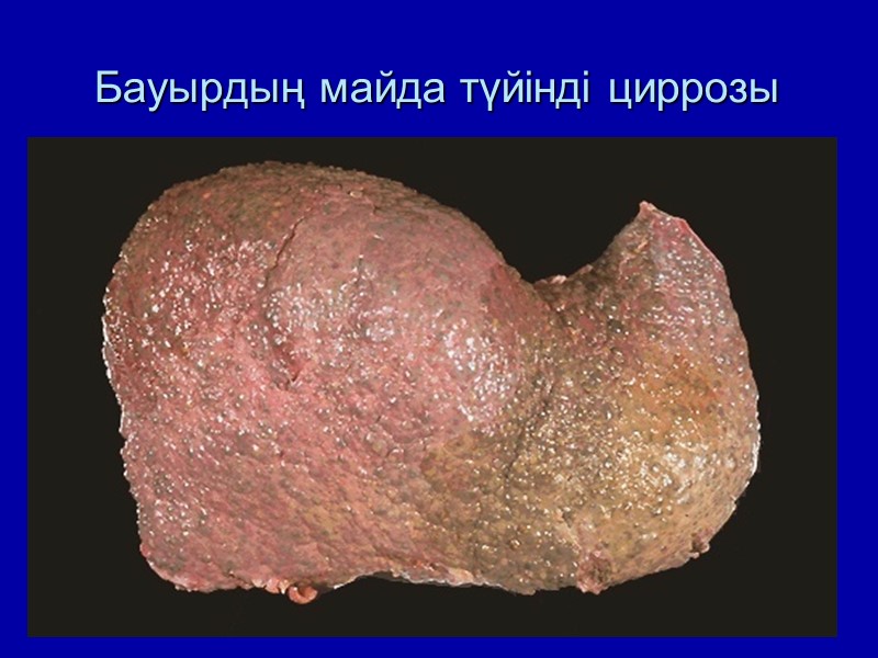 Бауырдың майда түйінді циррозы